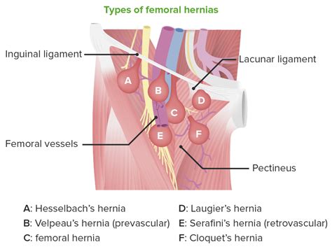 Femoral Hernia