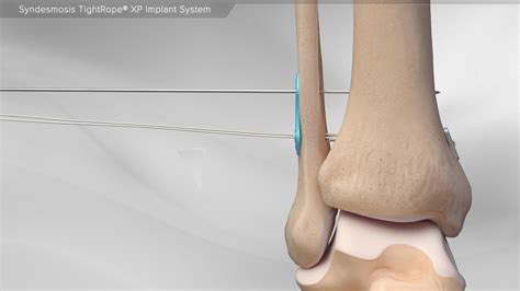 Arthrex - Syndesmosis TightRope® XP Implant System