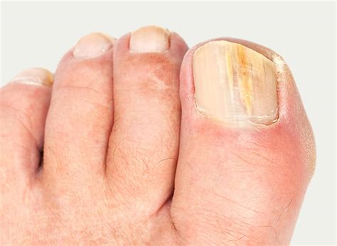 Fungal Nails - Davenport House Clinic