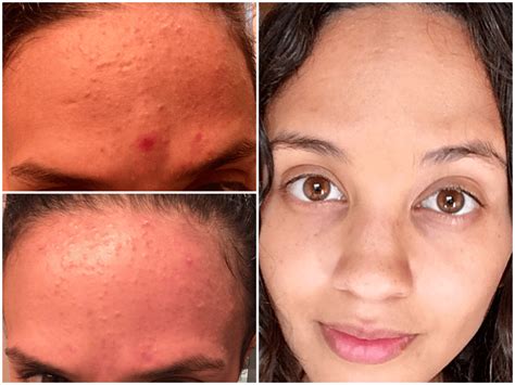 [B&A] cleared fungal acne : r/SkincareAddiction