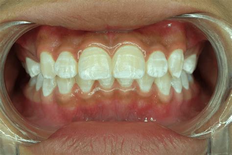 Manchas blancas en los dientes: ¿por qué aparecen? - Mejor con Salud