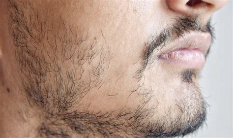 Stryx | How to Fix a Patchy Beard | 5 Proven Ways