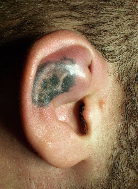 Datei:Hematoma ear.jpg – Wikipedia