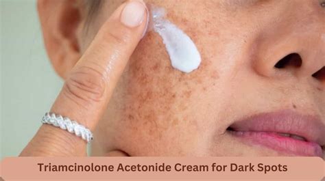 Triamcinolone Acetonide Cream for Dark Spots or Skin Lightening