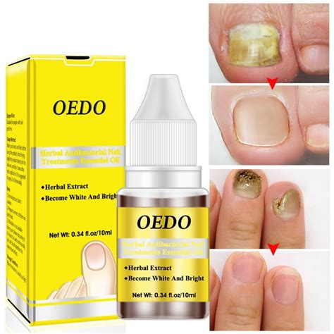 Psoriasis Nail Oil Treatment - Toenails, Fingernails, Skin Treatment, 0.34 fl oz - Walmart.com