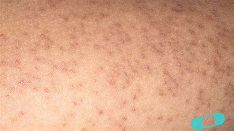 Mild Keratosis Pilaris