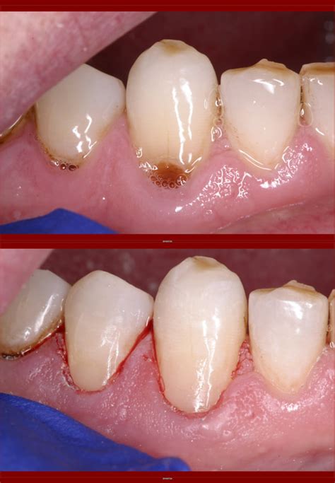 Composite Restorations (White Fillings)