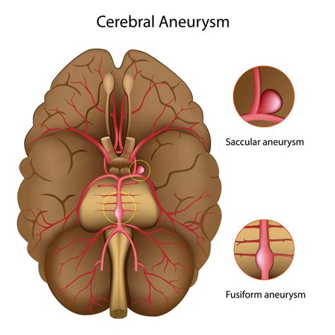 What You Need to Know About Brain Aneurysms - Premier Neurology & Wellness Center