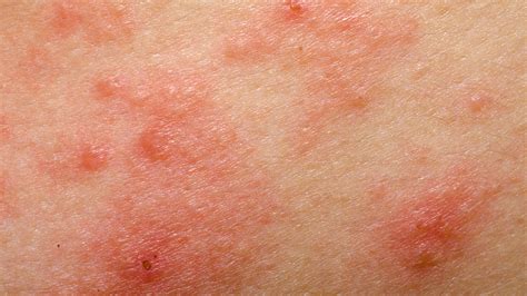 Eczema vs. Skin Cancer | GentleCure