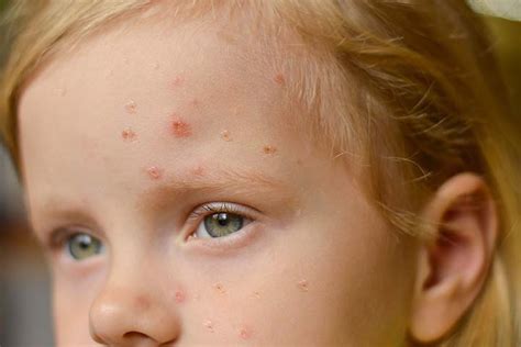 5 Causes Of Acne in Toddlers And How To Treat It? | MomJunction