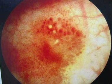 Hemorrhagic Cystitis: Practice Essentials, Anatomy, Pathophysiology