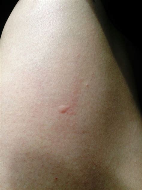 Can Dogs Get Mosquito Bites Bumps