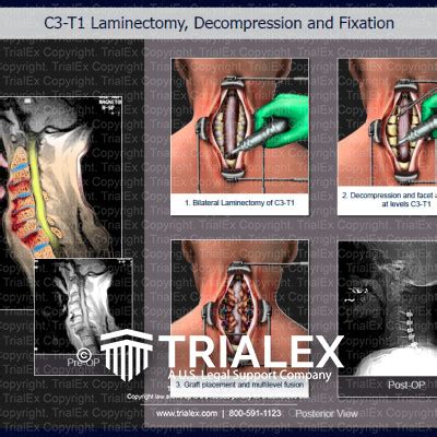 C3-T1 Laminectomy, Decompression and Fixation - TrialExhibits Inc.