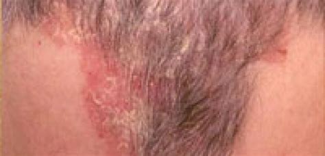 36+ Scalp Eczema Hair Loss - LindseyKievy