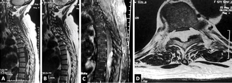 MRI: (A) sagittal T1-weighted image showing an epidural mass mostly... | Download Scientific Diagram