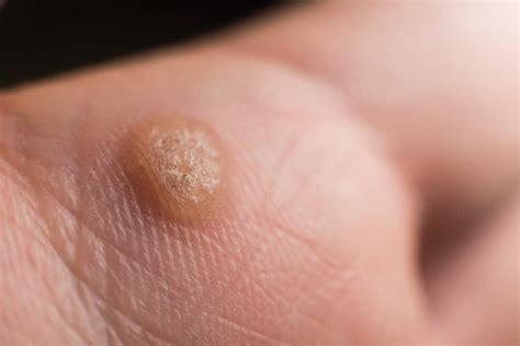 Warts and Molluscum | Pensacola Dermatology