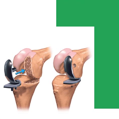 Knee Replacement Surgery - Expert Surgeries