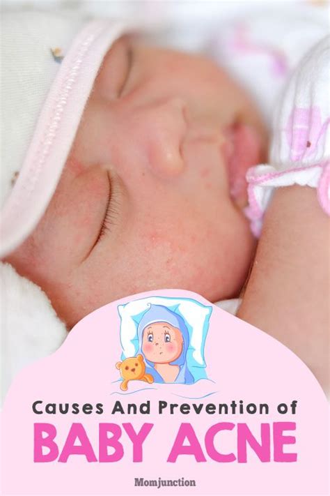 Baby Acne: What Causes Them And How You Can Prevent | Baby acne, My ...