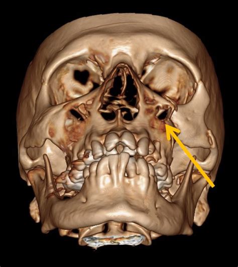 Fig. (2). 3-D reconstructed CT scan image showing left side inward ...