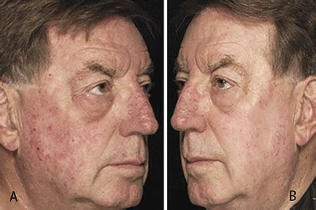 Actinic Keratoses - Three Rivers Dermatology | Coraopolis, PA Dermatologist