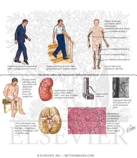 Mononeuritis Multiplex with Polyarteritis Nodosa