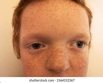 161 Exotropia Images, Stock Photos & Vectors | Shutterstock