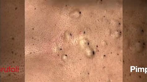 Multiplex Steatocystoma Removal Blackheads Brufoli Pimple - YouTube