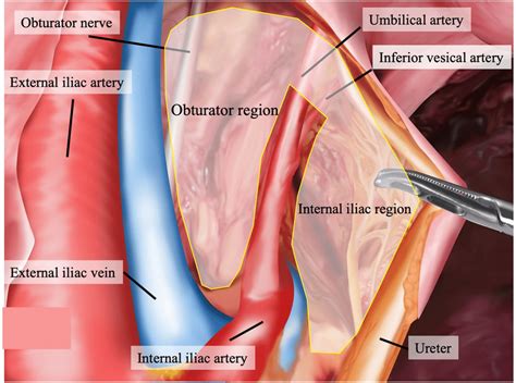 Lymph nodes in the internal iliac region are resected en bloc with ...