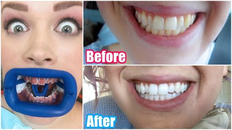 My Professional Teeth Whitening Experience! BEFORE & AFTER - YouTube