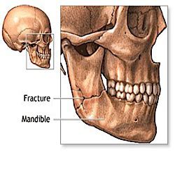 Jaw Fractured/Dislocated