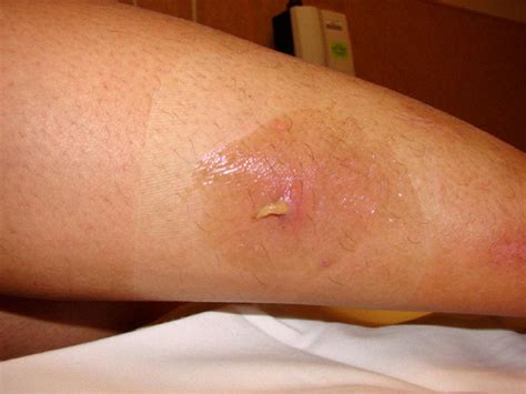 Furuncular Myiasis From Dermatobia Hominus: A Case of Human Botfly Infestation - Journal of ...