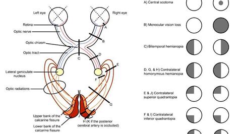 Homonymous hemianopsia