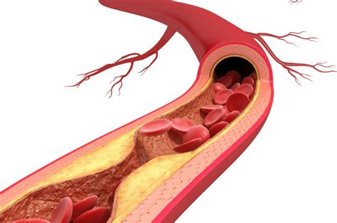 What Are Symptoms of a Blocked Artery in Your Leg?