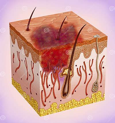 Bruising, Bruising or Bruising. Stock Illustration - Illustration of bruise, blemish: 95303495