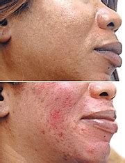 The dangers of skin bleaching | The Tribune