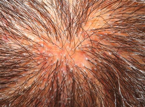 Lichen Planus Scalp Symptoms