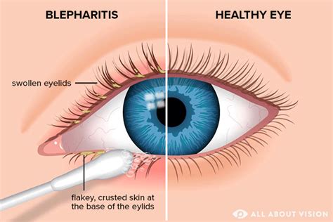 Blepharitis (Eyelid Inflammation): Causes Treatment, 52% OFF