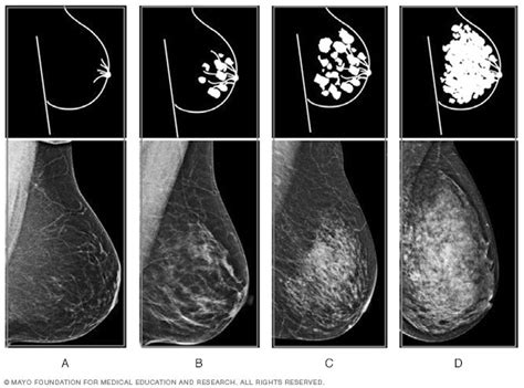 Dense breast tissue: What it means to have dense breasts - Mayo Clinic