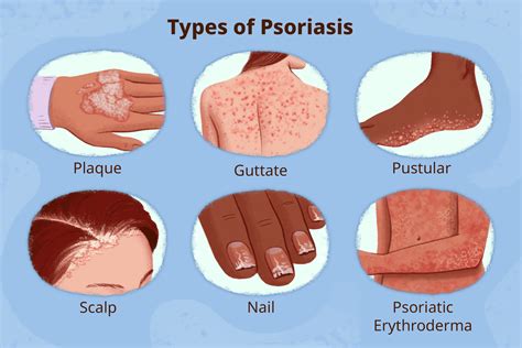 Types of Psoriasis - MEDizzy