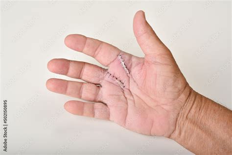 A New Chapter Begins: Trigger Finger Surgery Unveiled - Institute of ...