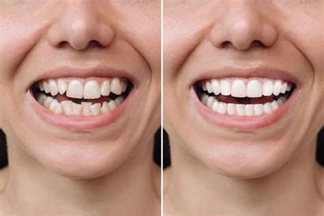 Effective Hydrogen Peroxide Teeth Whitening: A Guide