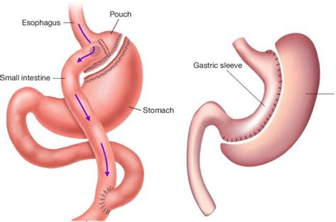 What is the difference between gastric sleeve and bypass?