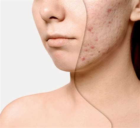 Acne Scarring | Acne Scarring Treatment | Wentworth Aesthetics