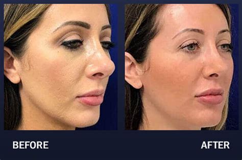 Cheek Filler Before & After Pictures | Madnani Facial Plastic Surgery