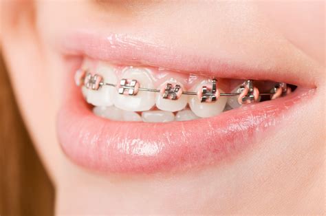 Different Color Brackets For Braces - bmp-syrop