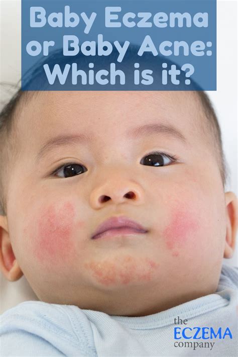 Pin on Eczema Treatments: Babies & Young Children