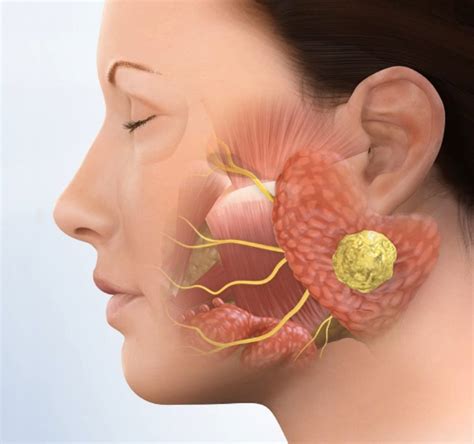 After Parotid Gland Surgery - ENT Clinic