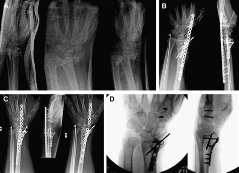 Complications Associated with Distraction Plate Fixation of Wrist ...