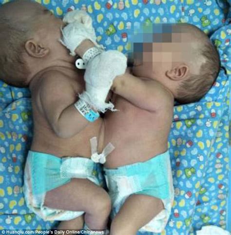 Chinese twins conjoined at the abdomen are separated | Daily Mail Online