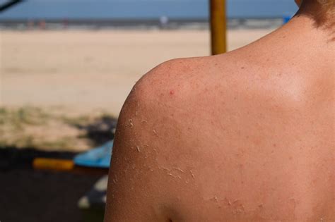 How Bad Of A Sunburn Causes Cancer - CancerWalls